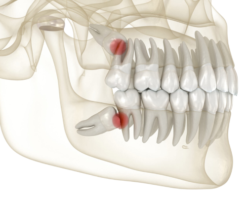 Wisdom Tooth Surgery